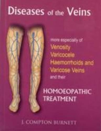Diseases of the Veins: More Especilly of Venosity, Varicocele, Hemmorrhoids &