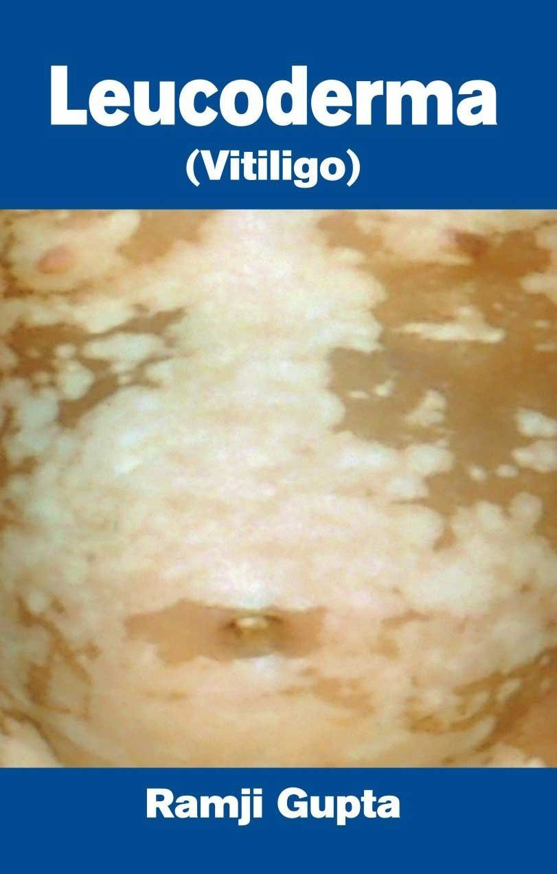 Leucoderma - Vitilgo: Diseases of White Patches [Feb 01, 2008] Gupta, Ramji] [[Condition:Brand New]] [[Format:Paperback]] [[Author:Ramji Gupta]] [[ISBN:812690805X]] [[ISBN-10:812690805X]] [[binding:Paperback]] [[manufacturer:Atlantic Publishers &amp; Distributors (P) Ltd.]] [[number_of_pages:80]] [[package_quantity:5]] [[publication_date:2007-06-20]] [[brand:Atlantic Publishers &amp; Distributors (P) Ltd.]] [[ean:9788126908059]] for USD 13.33